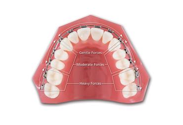 Trifecta Thermal Nickel Titanium Full Form Archwire Rectangle Etched